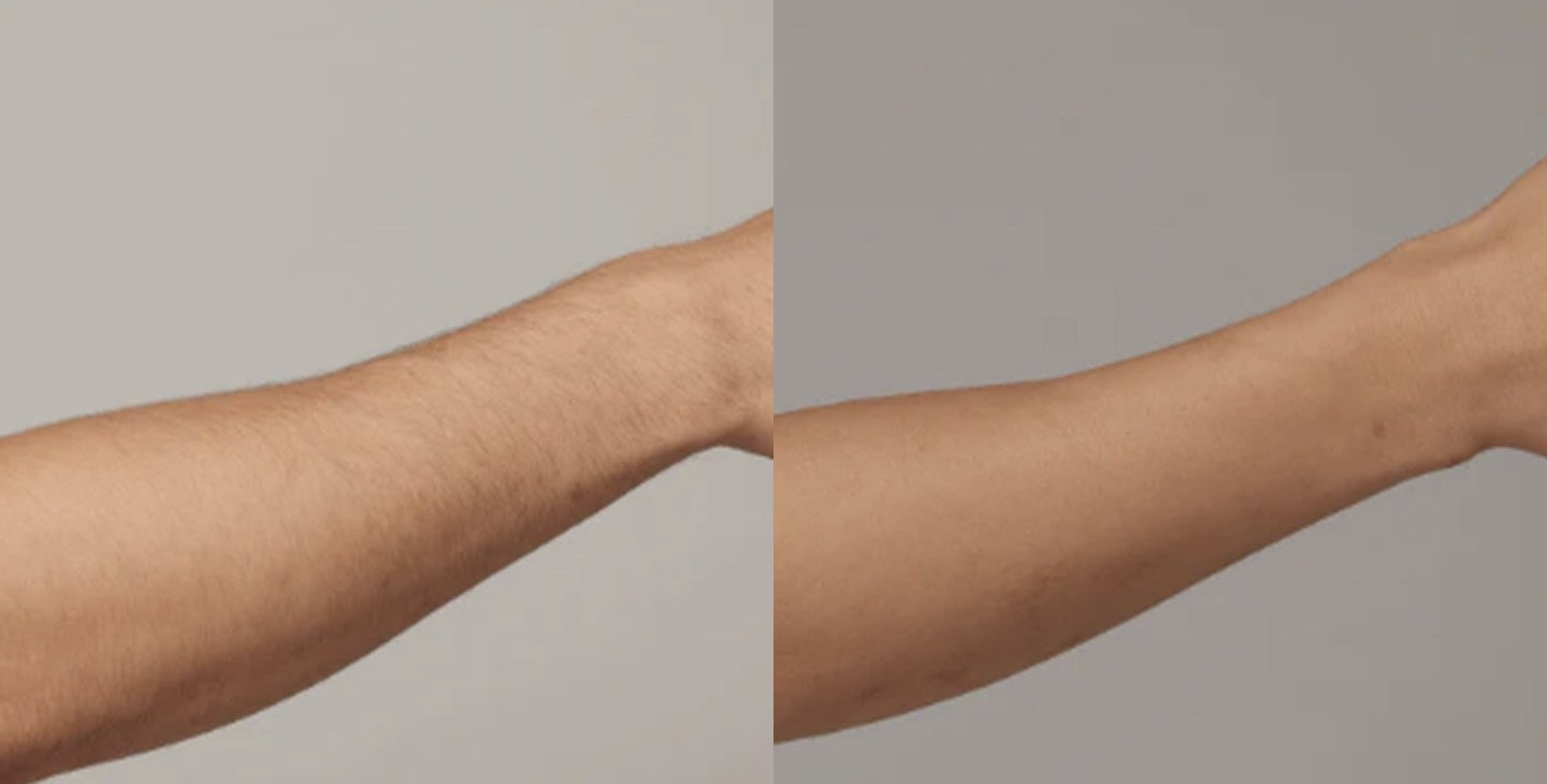 Arms: before on the left, after on the right