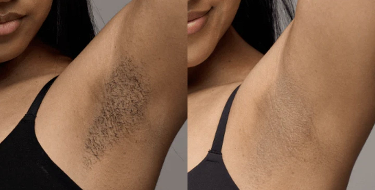 Underarms, before